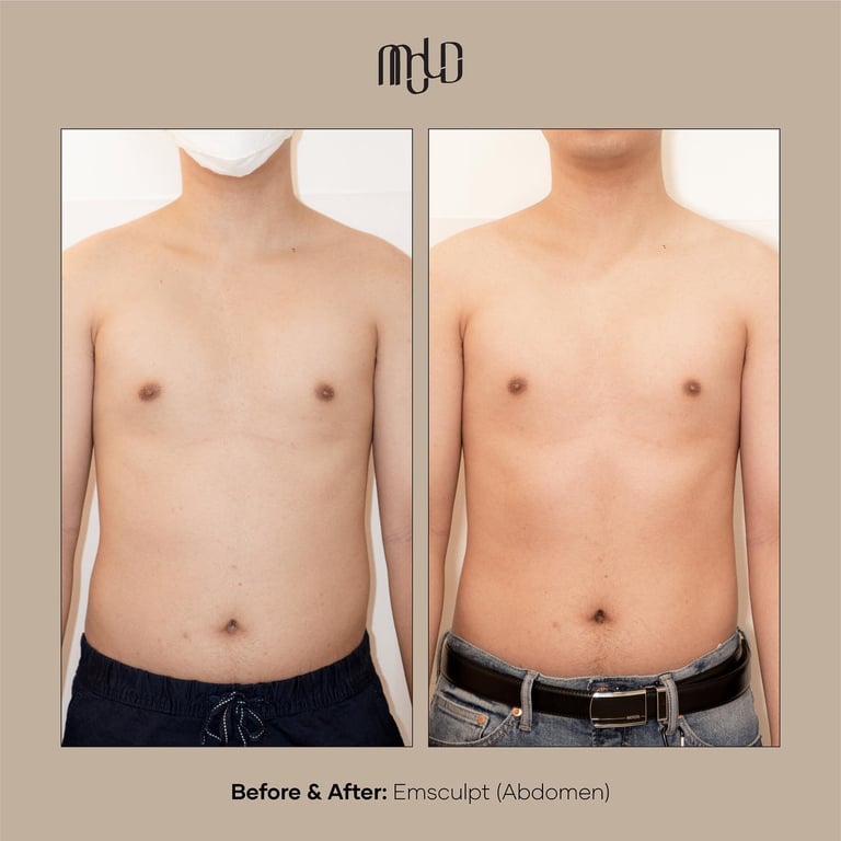 Emsculpt Treatment before and After by MOLD Manila