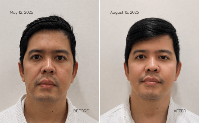 MOLD Manila Shares Three-Month Patient Results From XERF Skin Tightening